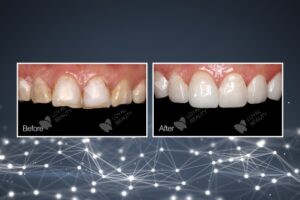 The most suitable treatment plan for the zirconia crown