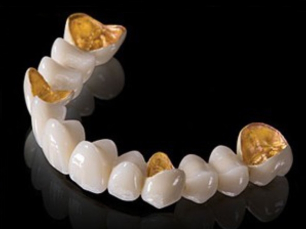 Captek par conception dentaire