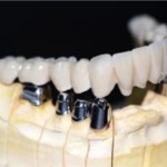 Dental Implant