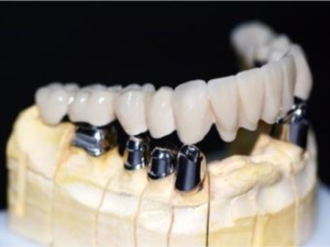 Dental Implant