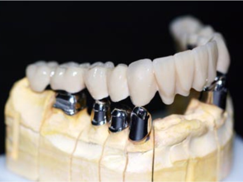 Dental Implant