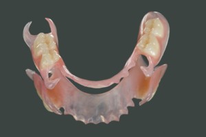 Couronne et pont flexibles
