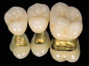 PFM Yellow Gold pour laboratoires dentaires