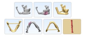 Perone Rebuild and mandible design by China Dental Laboratory