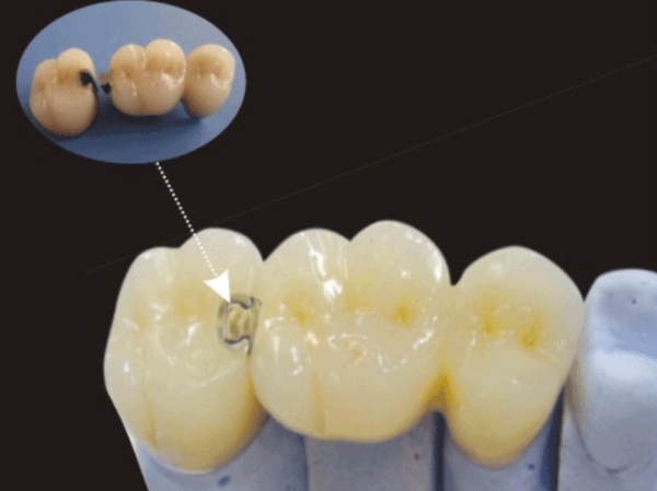 dental lab precision attachment