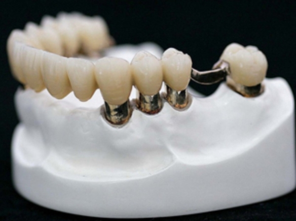 couronne et pont de porcelaine