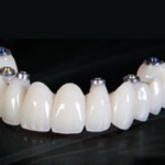 China Dental Outsourcing screw retained bridge