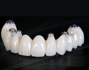 China Dental Outsourcing screw retained bridge