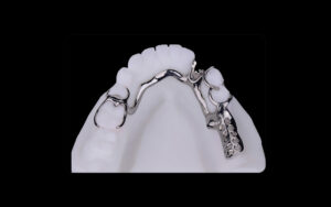 dental metal framework