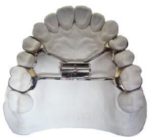 orthodontic treatment