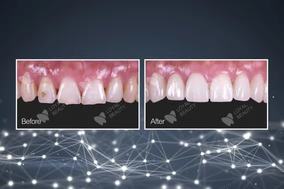 Flexible zirconia crown of trusted Chinese dental outsourcing