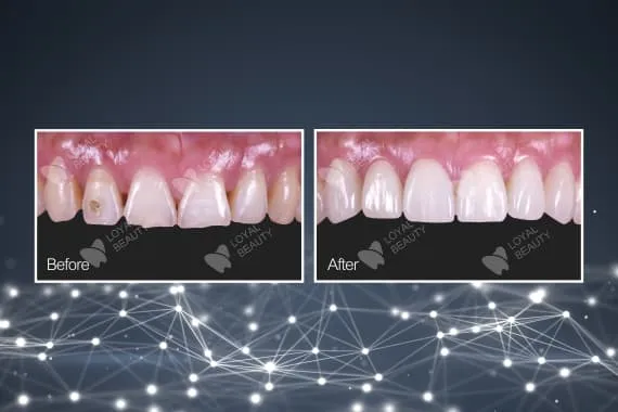 Flexible zirconia crown of trusted Chinese dental outsourcing Flexible zirconia crown of trusted Chinese dental outsourcing