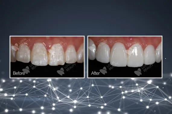 The most suitable treatment plan for the zirconia crown