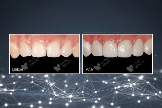 China Dentallabor Veneer
